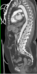 Plaque in Superior Mesenteric Artery (SMA) With SMA Stenosis - CTisus CT Scan