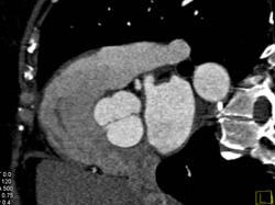 Bicuspid Valve - CTisus CT Scan