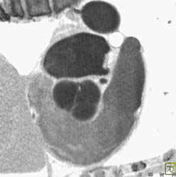 Bicuspid Valve - CTisus CT Scan