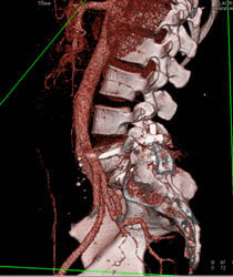 Pins Push Against Iliac Artery - CTisus CT Scan