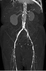 Diseased Iliac Artery With Occlusion of SFA - CTisus CT Scan