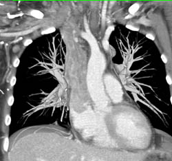 SVC Occlusion Due to Inflammatory Process - CTisus CT Scan