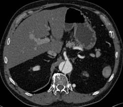 Aortic Dissection With Graft From Lower Thoracic Aorta to the SFA- See Left Paraspinal Zone - CTisus CT Scan