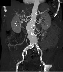 Aortic Aneurysm With VRT and MIP. IMA Only Seen With VRT - CTisus CT Scan