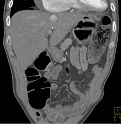 Clot in SMA Results in Ischemia - CTisus CT Scan