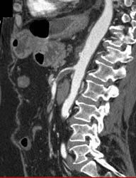 Superior Mesenteric Artery (SMA) Stenosis With Thrombus - CTisus CT Scan