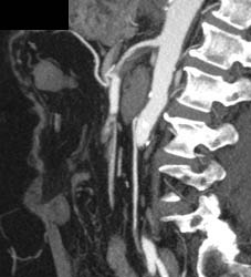 Multiple Stents in Aorta With Dissections - CTisus CT Scan