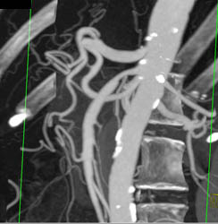 SMA Stenosis - CTisus CT Scan