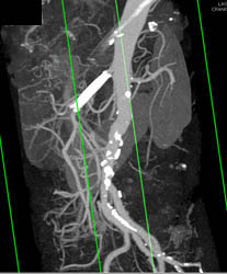 Trauma With Clavicle Fracture But No Vascular Injury - CTisus CT Scan