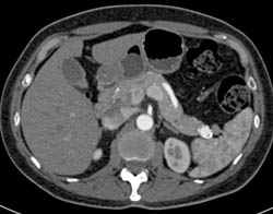 Splenic Artery Aneurysm Simulates An Islet Cell Tumor - CTisus CT Scan