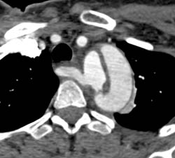 Type A Dissection With Aberrant Subclavian Artery - CTisus CT Scan