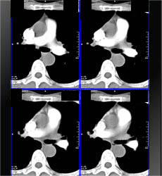 Timing of Aorta Enhancement - CTisus CT Scan