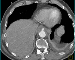 Celiac Occlusion - CTisus CT Scan