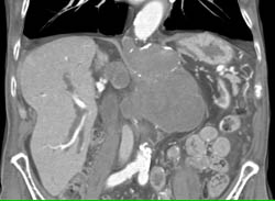 SMA Reimplantation - CTisus CT Scan