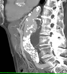 Abdominal Aortic Aneurysm (AAA) - CTisus CT Scan