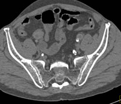 Severe Iliac and SFA Disease - CTisus CT Scan