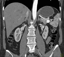 Splenic Artery Aneurysm - CTisus CT Scan