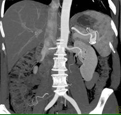 Splenic Artery Aneurysm - CTisus CT Scan