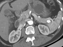 Splenic Artery Aneurysm - CTisus CT Scan