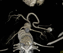 Splenic Artery Aneurysm - CTisus CT Scan