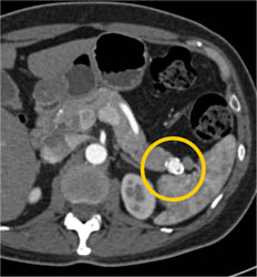 Splenic Artery Aneurysm - CTisus CT Scan