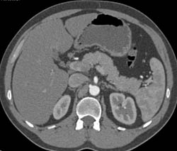 Duplicated Inferior Vena Cava (IVC) - CTisus CT Scan