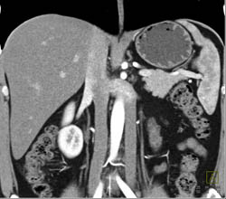 Duplicated Inferior Vena Cava (IVC) - CTisus CT Scan