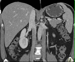 Duplicated Inferior Vena Cava (IVC) - CTisus CT Scan