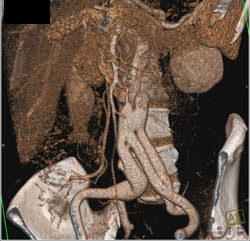 Iliac Repair - CTisus CT Scan