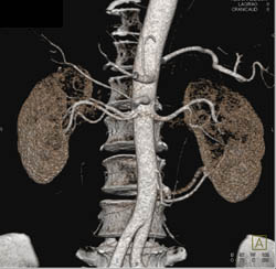 Multiple Renal Arteries and Veins - CTisus CT Scan