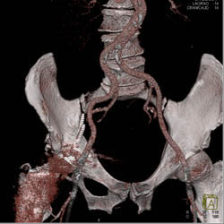 Screws Right Acetabulum Are Near Iliac Vessels and SFA - CTisus CT Scan