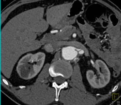 Dissection of Left Renal Artery - CTisus CT Scan