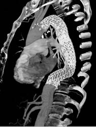 Endovascular Stent for Arch Repair Using Automatic Vascular Mapping Software - CTisus CT Scan