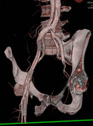 Stents to Treat Multiple Vessel Dissections - CTisus CT Scan