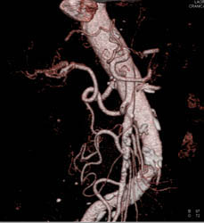 SMA Disease - CTisus CT Scan