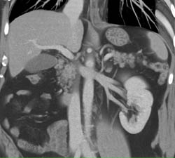 Superior Mesenteric Artery (SMA) Stenosis - CTisus CT Scan