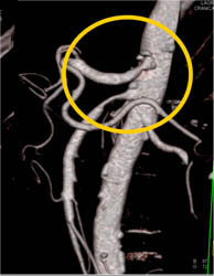 Superior Mesenteric Artery (SMA) Stenosis - CTisus CT Scan