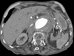 Thrombosed Leak of Aortic Aneurysm - CTisus CT Scan