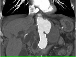 Ulceration of Abdominal Aorta - CTisus CT Scan