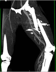 Femur Fracture S/P GSW Without Vascular Injury - CTisus CT Scan