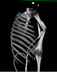 Humerus Fracture Without Vascular Injury - CTisus CT Scan