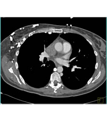 SVC Occlusion Extends Into Right Atrium With Collateral Pathways - CTisus CT Scan