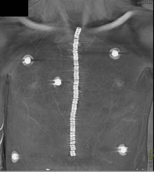 Prior Medial Sternotomy- Lots of Staples - CTisus CT Scan