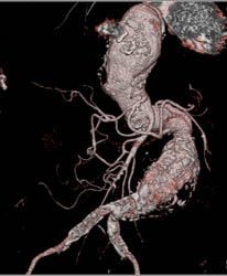 Ectatic Abdominal Aortic Aneurysm - CTisus CT Scan