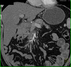 Encased Superior Mesenteric Artery (SMA) and Superior Mesenteric Vein (SMV) in Sclerosing Mesenteritis - CTisus CT Scan