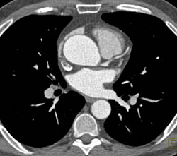 Dilated Ascending Aorta and Aortic Stenosis - CTisus CT Scan