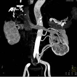 3 Left Renal Arteries in A Donor - CTisus CT Scan