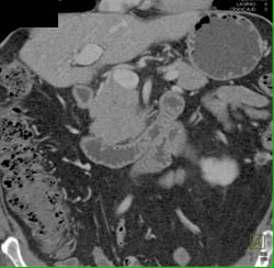 Low Origin to Left Renal Vein - CTisus CT Scan