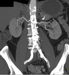 Branching of Renal Artery - CTisus CT Scan