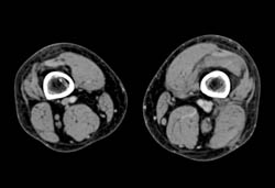 Popliteal Artery Occlusion- Multiple Veins - CTisus CT Scan